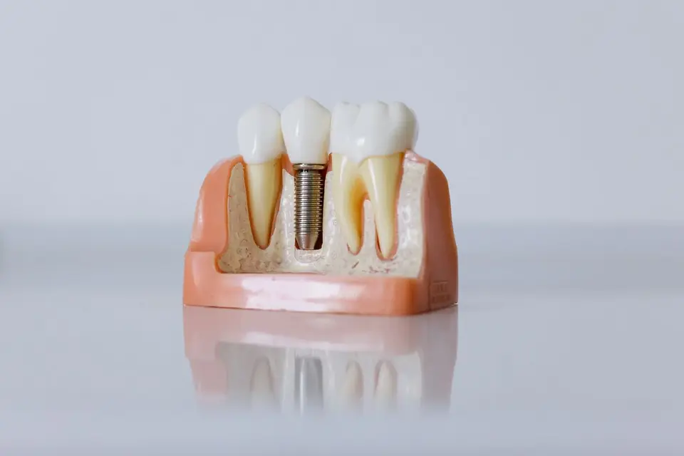 Detailed dental implant model showcasing teeth structure for educational purposes.